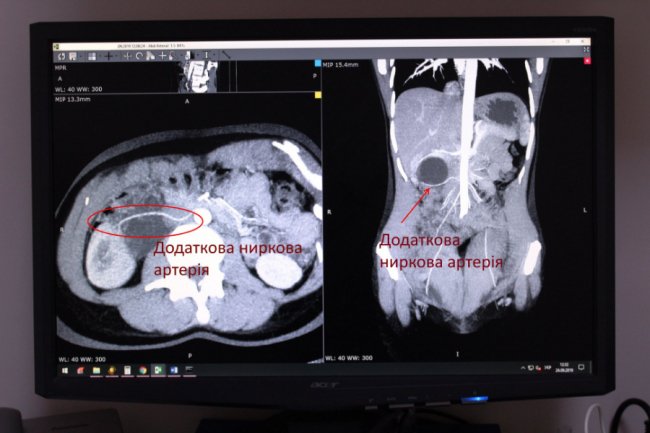 Вперше на Волині пацієнтці зробили надскладну операцію на нирці без єдиного розрізу