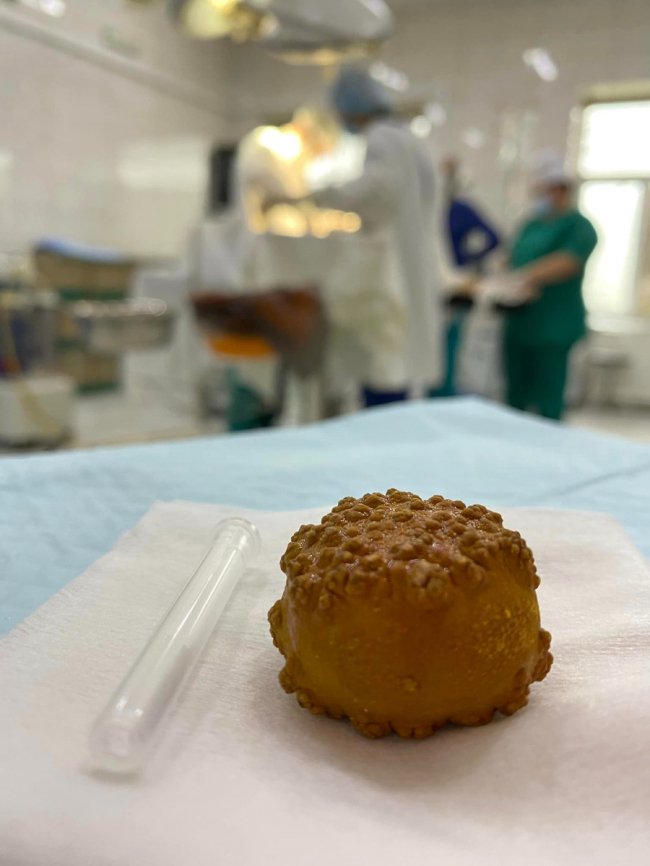 Лікарі видалили волинянину величезний камінь із сечового міхура. ФОТО