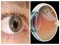 Методи діагностики та лікування захворювання сітківки ока*