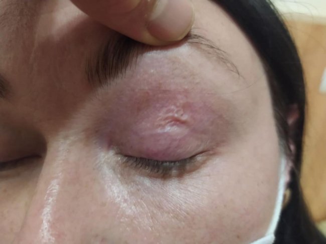 На Волині у жінки з ока дістали 9-сантиметрового гельмінта. ФОТО