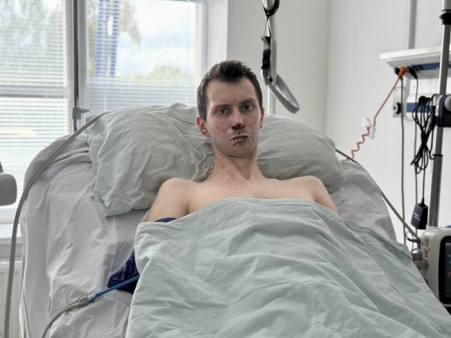 Львівські медики врятували 30-річного захисника з Волині, який обпік 50% тіла
