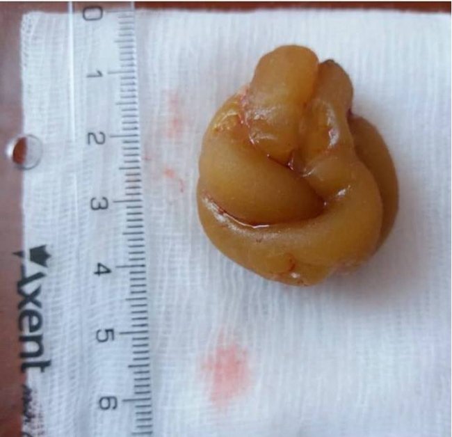 У сечовому міхурі волинянина лікарі знайшли... свічку. ФОТО