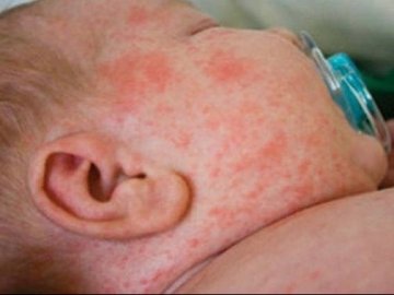 На Волині двоє немовлят захворіли на кір