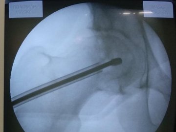 Волинські медики провели унікальну операцію з видалення кисти зі стегнової кістки пацієнта