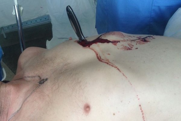 Щоб не йти на суд, волинянин встромив ніж собі у груди. ФОТО 18+