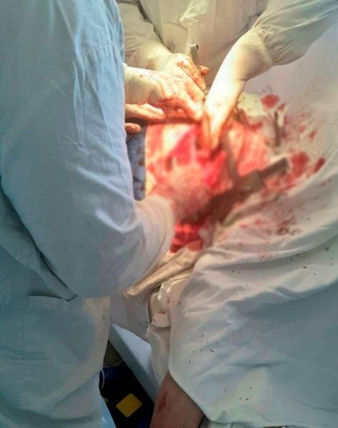 Щоб не йти на суд, волинянин встромив ніж собі у груди. ФОТО 18+