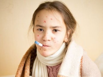На Волині очікують спалах кору: де можна вакцинуватись. АДРЕСИ