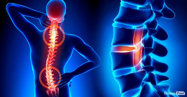 Остеохондроз хребта - чим небезпечна хвороба, методи лікування*