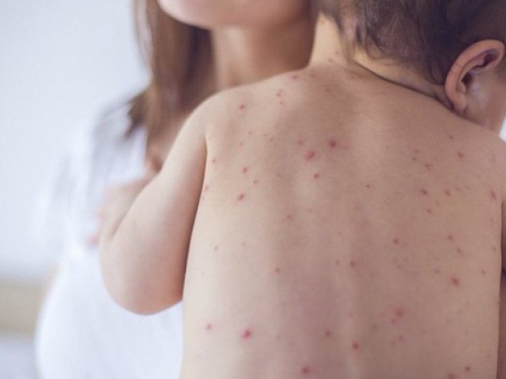 В Україні росте захворюваність на кір, пік очікують на осінь, - ЦГЗ