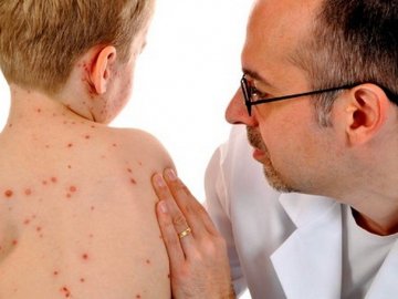 У Луцьку знову зафіксували кір