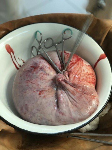 У луцькій лікарні жінці видалили величезну 4-кілограмову пухлину. ФОТО 18+