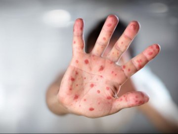 Через релігійні переконання матері двоє дітей з Волині підхопили кір