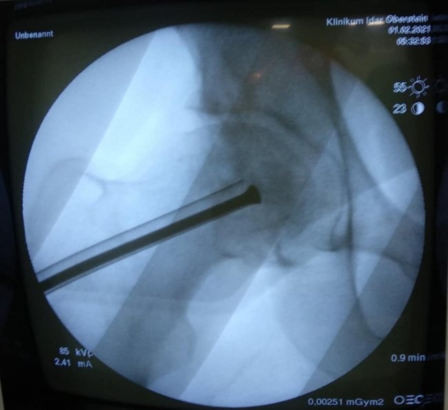 Волинські медики провели унікальну операцію з видалення кисти зі стегнової кістки пацієнта