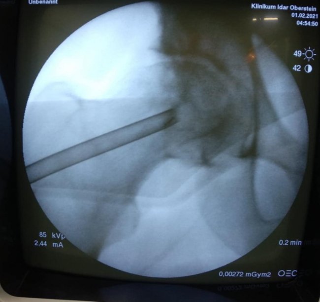 Волинські медики провели унікальну операцію з видалення кисти зі стегнової кістки пацієнта