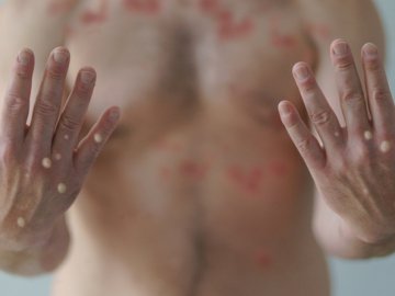 Що варто знати про вірус мавпячої віспи