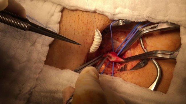 Врятували ноги від ампутації: волинські лікарі провели складну операцію на судинах. ФОТО 18+