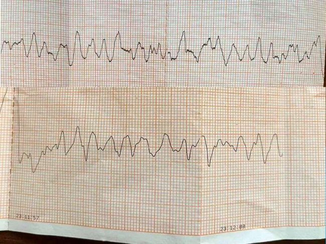 На Волині медики «швидкої» врятували чоловіка, у якого зупинилося серце