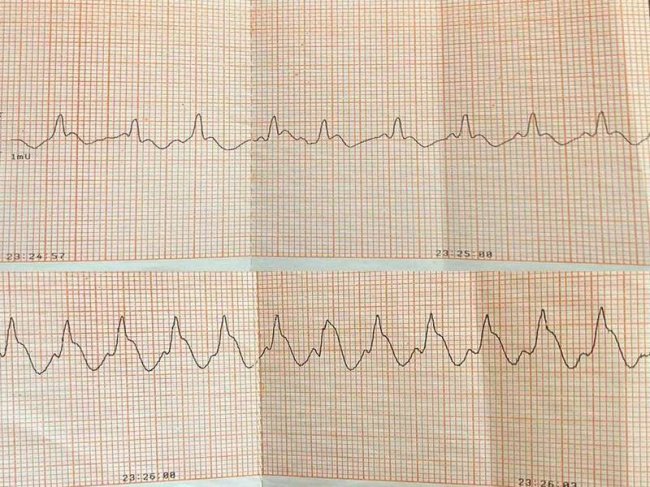 На Волині медики «швидкої» врятували чоловіка, у якого зупинилося серце