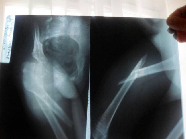 Для 6-річної дівчинки з Луцька потрібна реабілітація: мама благає про допомогу