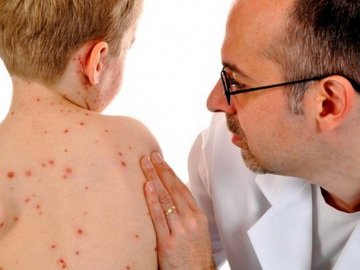 Кір показав проблеми зі щепленнями на Волині, - лікар