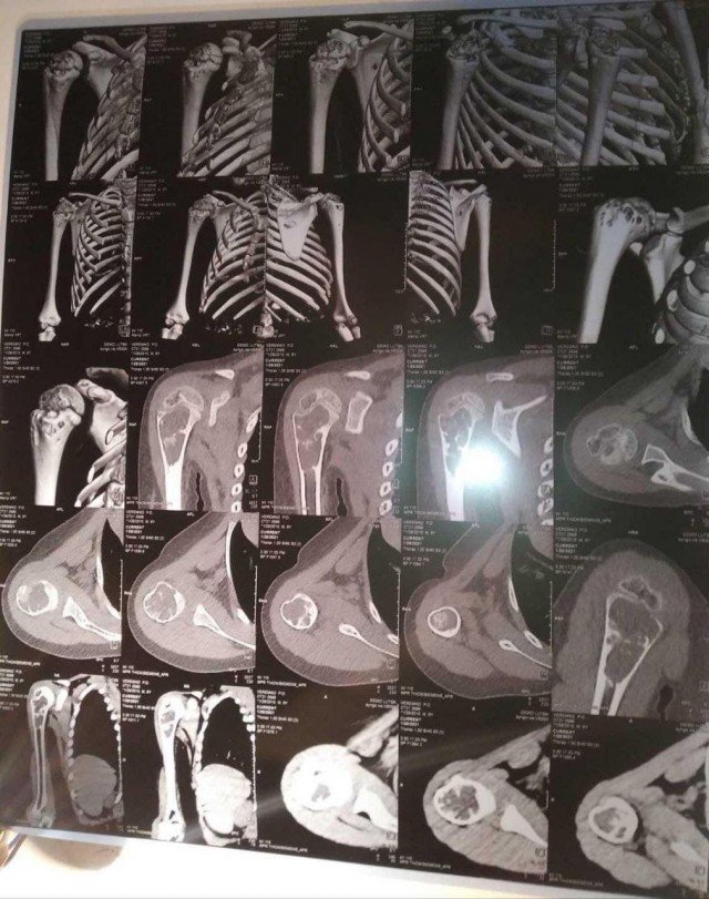 6-річному хлопчику з Волині  потрібна допомога небайдужих