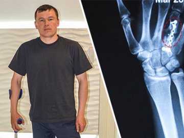 Втрачається дорогоцінний час: волинському бійцю збирають гроші на операцію