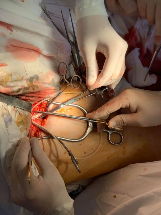 Волинські лікарі врятували від ампутації ногу пацієнта. ФОТО 18+