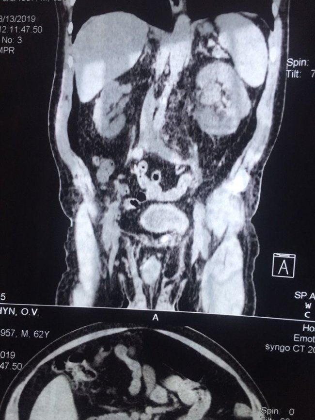 Волинянину провели три операції під час одного наркозу. ФОТО
