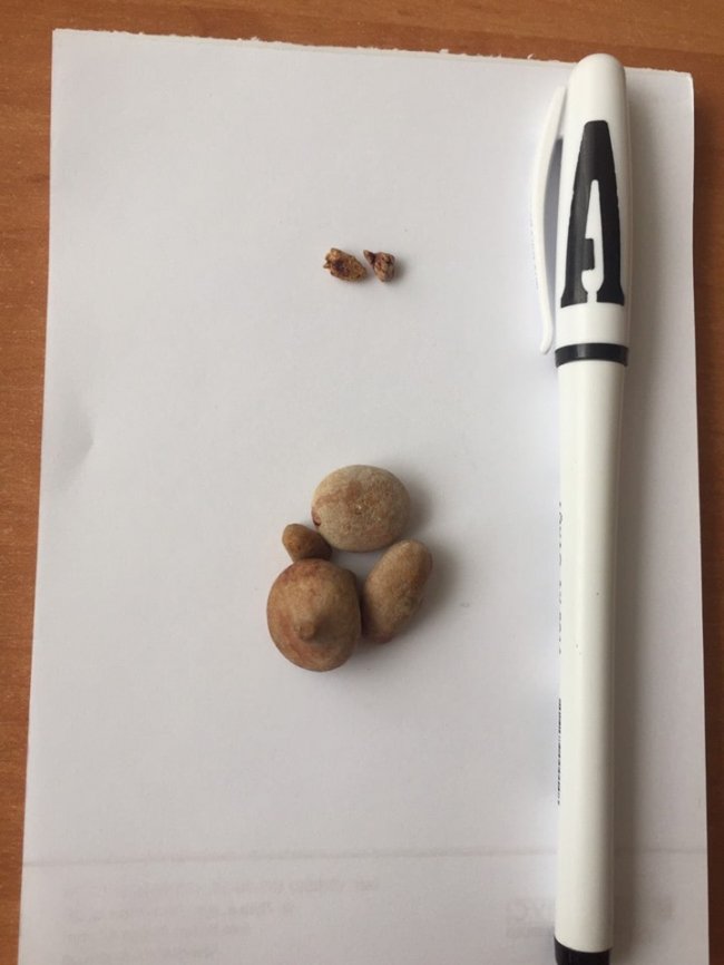 Волинянину провели три операції під час одного наркозу. ФОТО