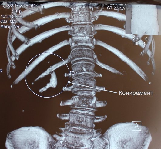 «Дробимо як горішки»: ковельські лікарі видалили величезний камінь з нирки