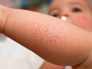 На Львівщині від кору померла 3-річна дитина