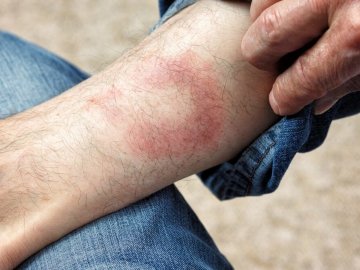 Сезон кліщів: на Волині зареєстрували цьогоріч 18 випадків хвороби Лайма