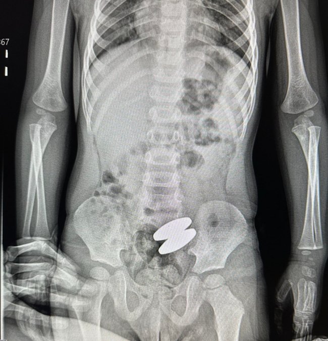 На Волині 2-річний хлопчик проковтнув два магніти, які були прикріплені на холодильнику