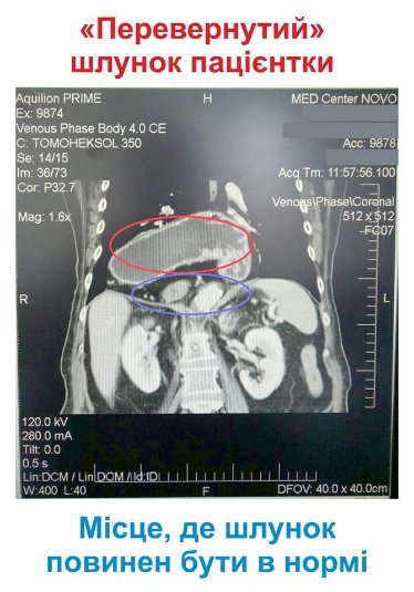 У луцькій лікарні вперше прооперували жінку з великою грижею новим методом