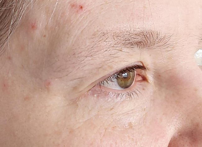 Волинські медики відновили зір жінці, яка його повністю втратила. ФОТО