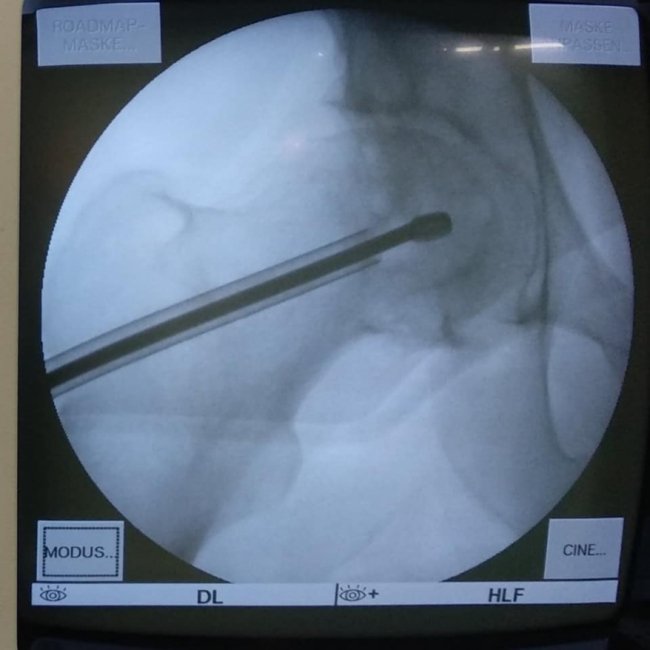 Волинські медики провели унікальну операцію з видалення кисти зі стегнової кістки пацієнта