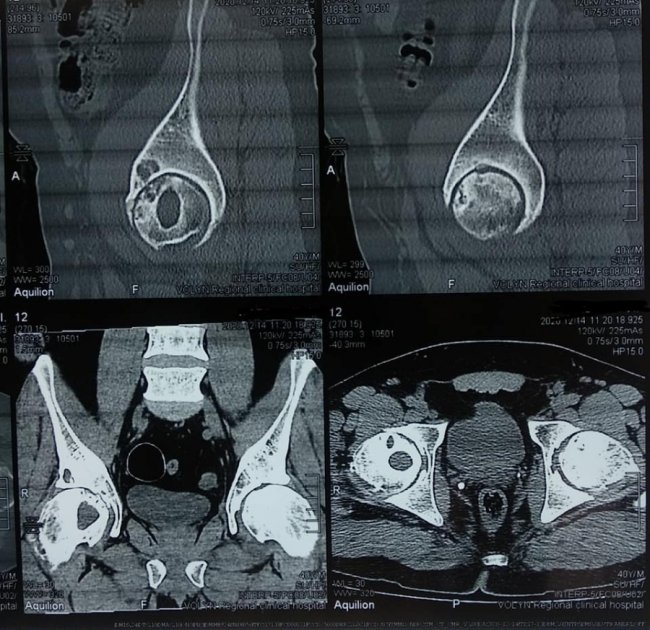 Волинські медики провели унікальну операцію з видалення кисти зі стегнової кістки пацієнта