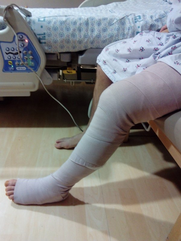 Герой з Волині, який лікується в Ізраїлі, зміг стати на ноги. ФОТО