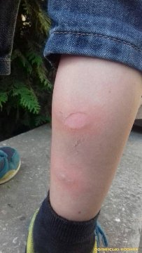 Дитина отримала опіки у луцькій маршрутці