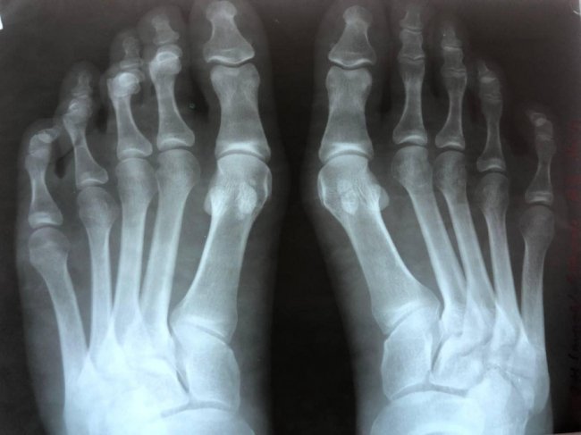 Лікарі прооперували 24-річну волинянку, у якої були викривлені пальці обох стоп 