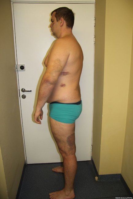 Відрізане вухо, проколи на руках, ‒ катування Булатова. ФОТО