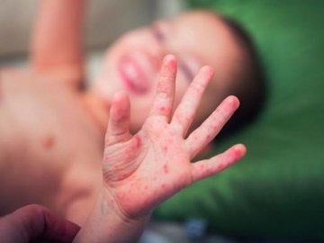 У школі на Волині – новий хворий на кір