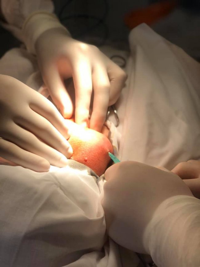 Ходив так три роки: на Волині чоловіку видалили чималу пухлину з шиї. ФОТО 18+ 