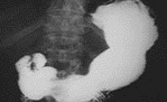 Як підготуватися до рентгеноскопії шлунка*