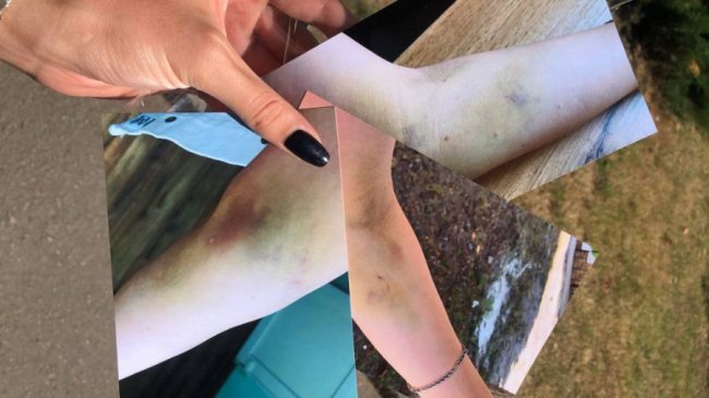 Ніби руку трамвай переїхав: у волинянки після здачі крові з'явилися величезні гематоми