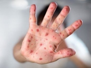 Луцьку школярку, яка перехворіла кором, не допускають до навчання. ВІДЕО