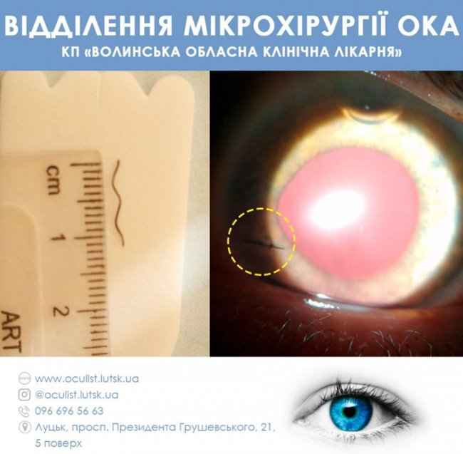 У волинській лікарні з ока чоловіка дістали 13-міліметрову дротинку 