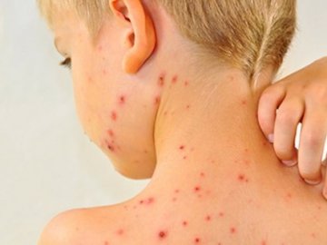 «Ситуація дуже критична», – Савченко про кір на Волині