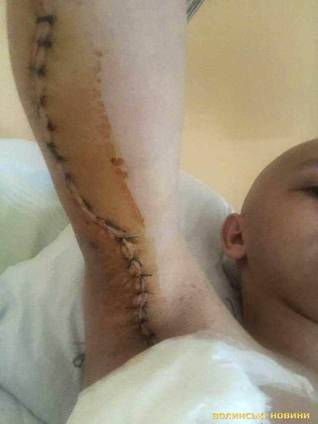 У двадцятирічного юнака, який поборов рак, стався рецидив: хлопець благає про допомогу