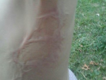 Потрібні кошти на реабілітацію 3-річної волинянки з опіками 40% тіла